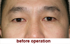 plastic-surgery-blepharoplasty